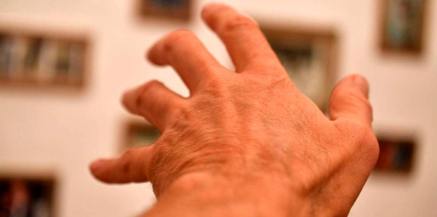 Parkinson's generates stiffness in the hands.
